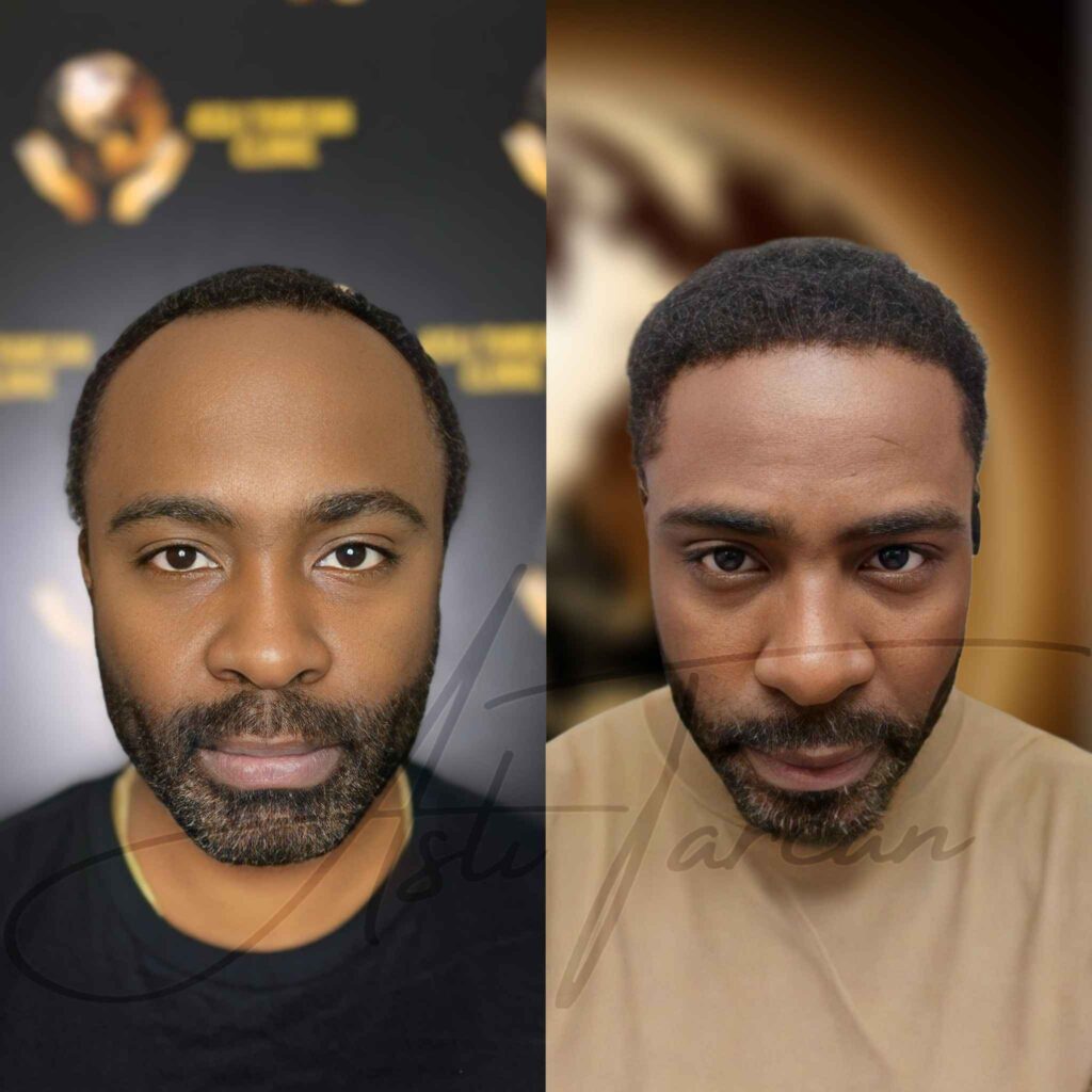 Afro Haartransplantation Türkei vorher nachher