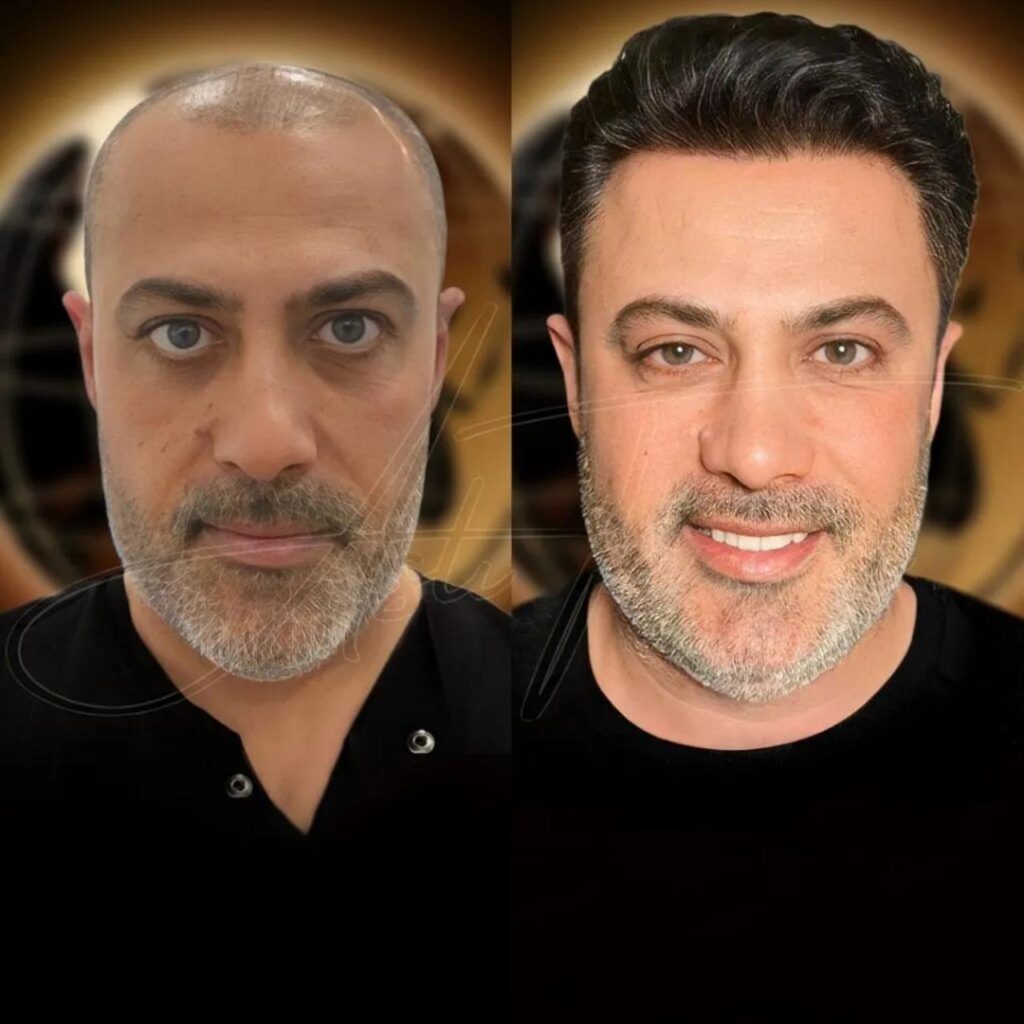 Best Hair transplant Turkey before and after 4