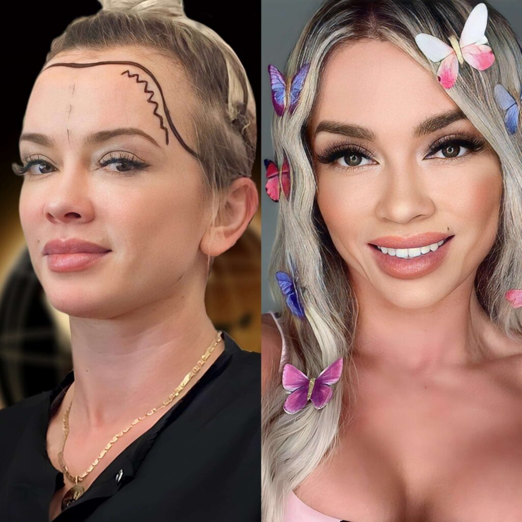 Haartransplantation Türkei Frauen vorher nachher