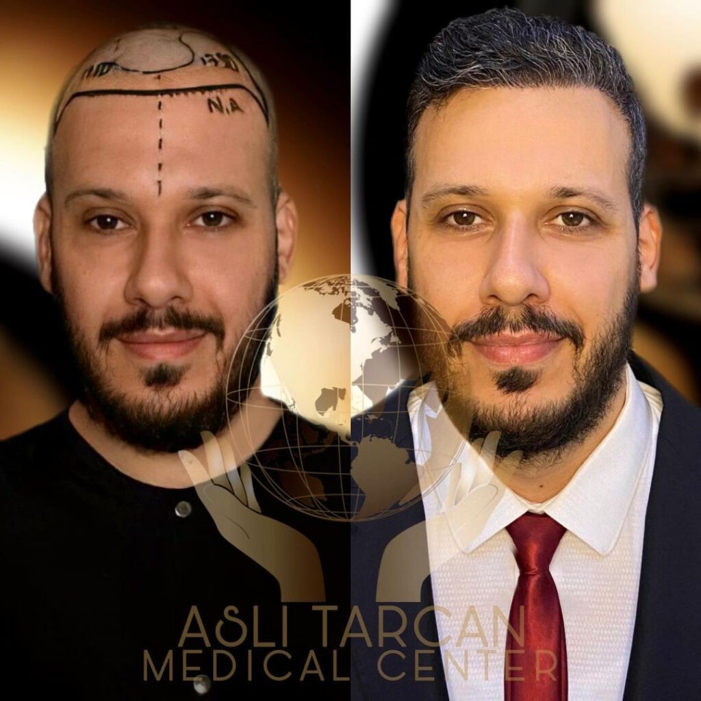 Haartransplantation Türkei vorher und nachher