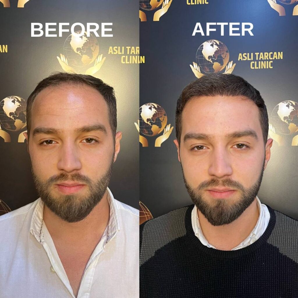 Top 10 Best Hair transplant turkey before and after