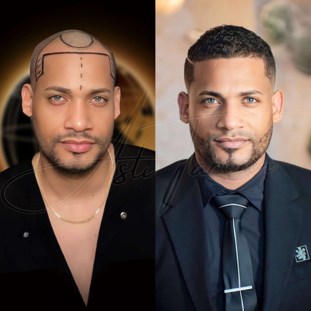 Top 5 Best Hair transplant Turkey before and after