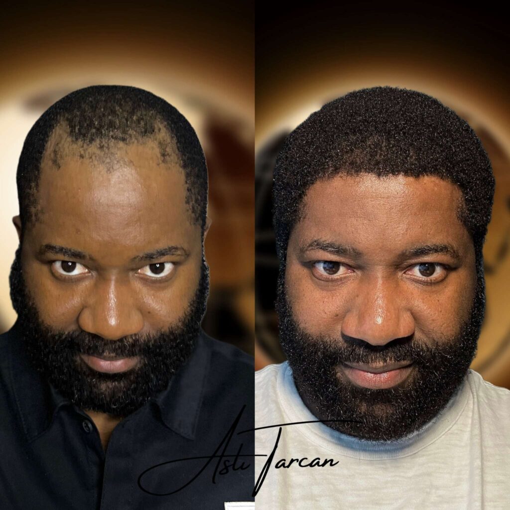 Top 5 best afro hair transplant turkey 1