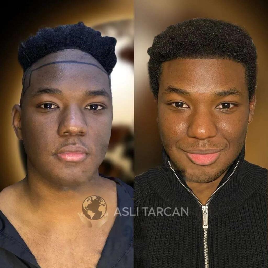best afro hair transplant before and after 1